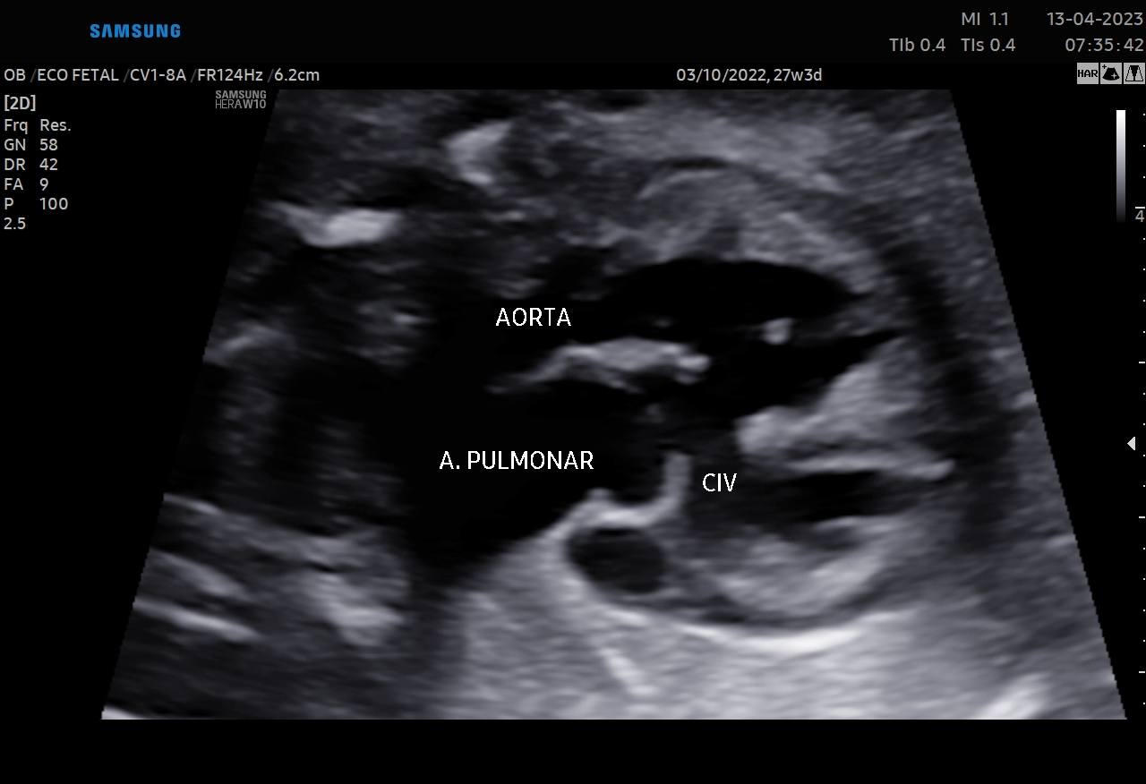 Ecocardiografia fetal na Clínica Ló em Sorriso, MT — Estudo detalhado da anatomia, do ritmo e da função cardíaca do bebê.